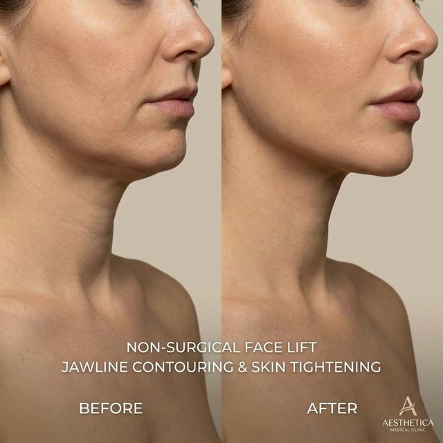 Лифтинг эффект