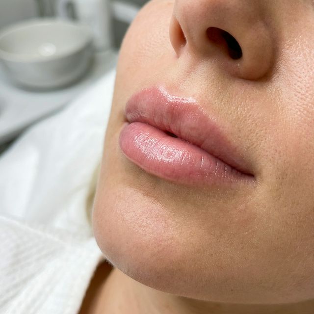 Коррекция формы губ